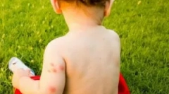 Šta da radim ako bebe bit insekti?